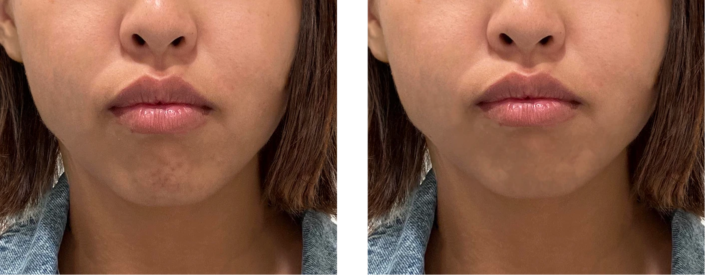 Mentalis strain icon